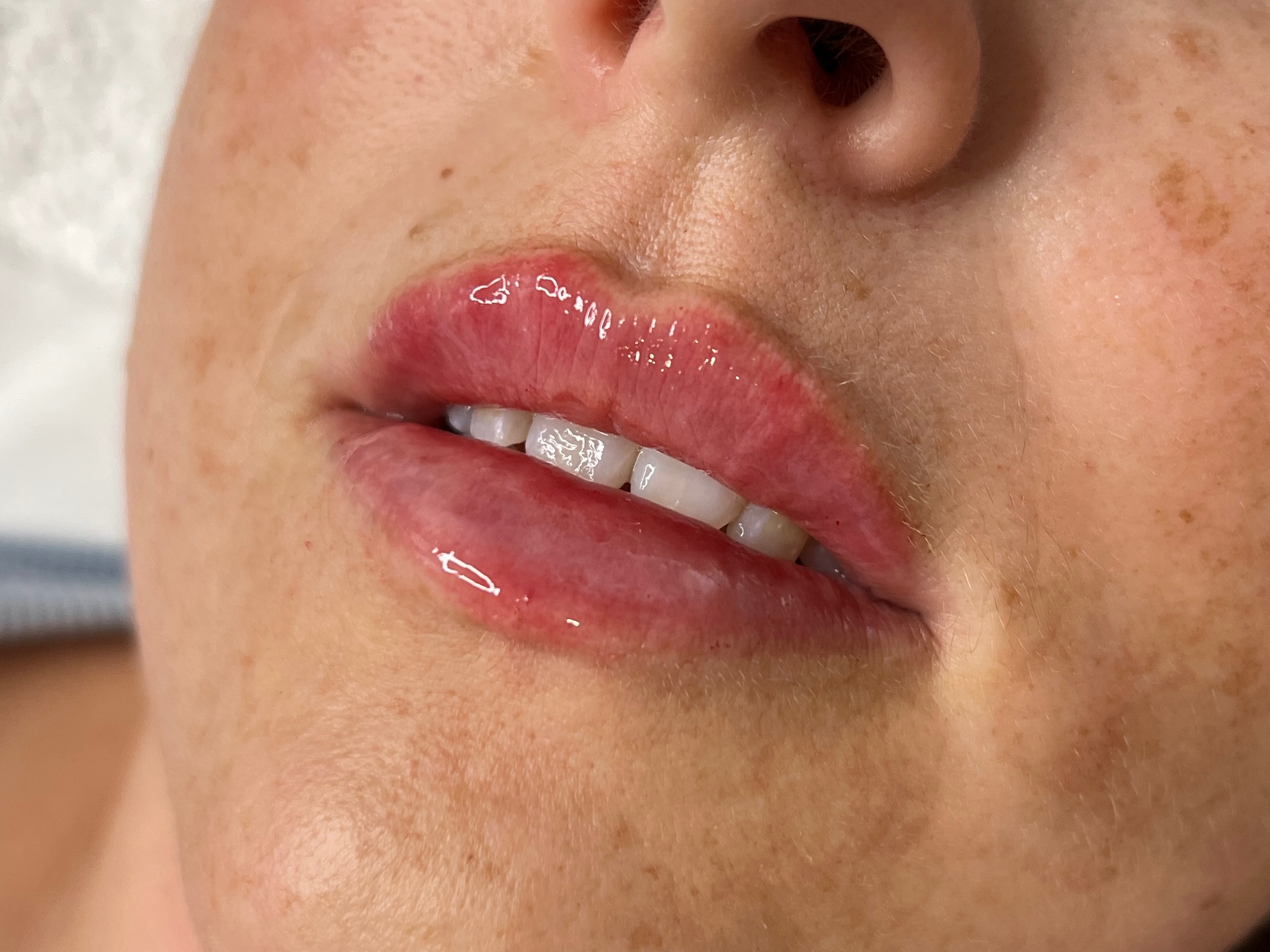 Russian Lip Filler