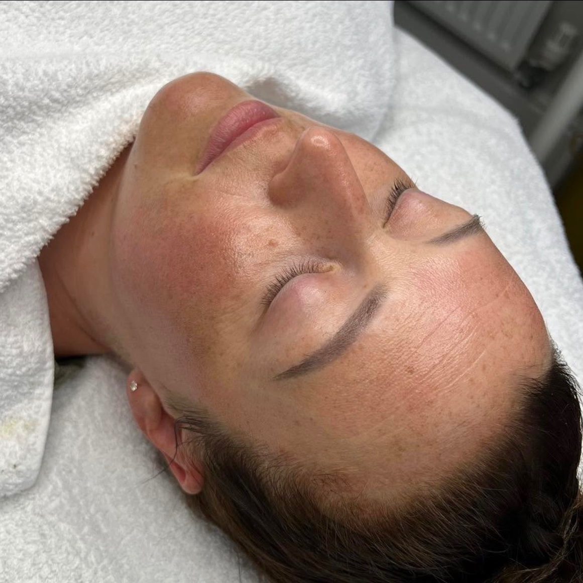 Premium Microneedling Facial With Premium Serums