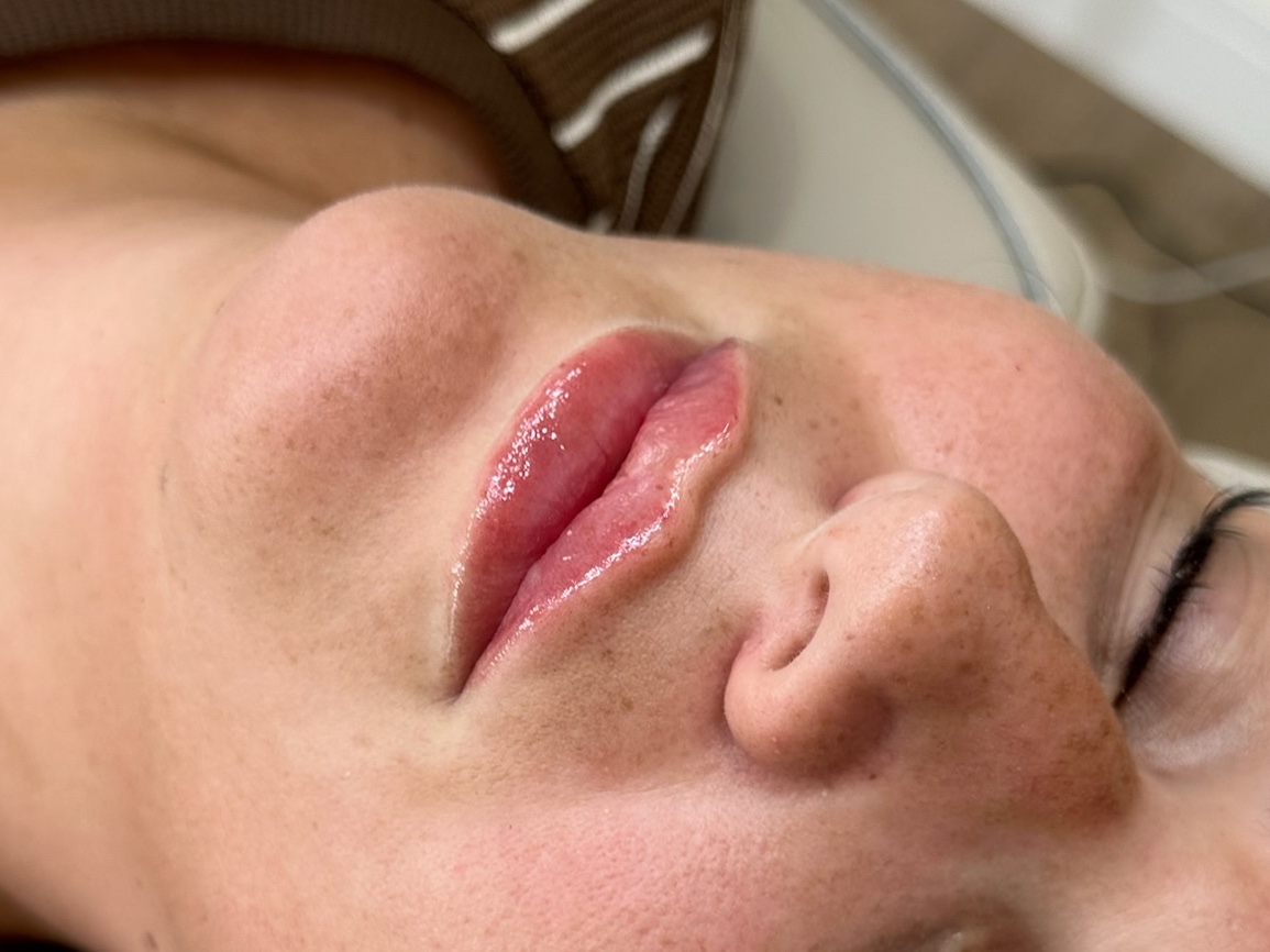 Lip filler